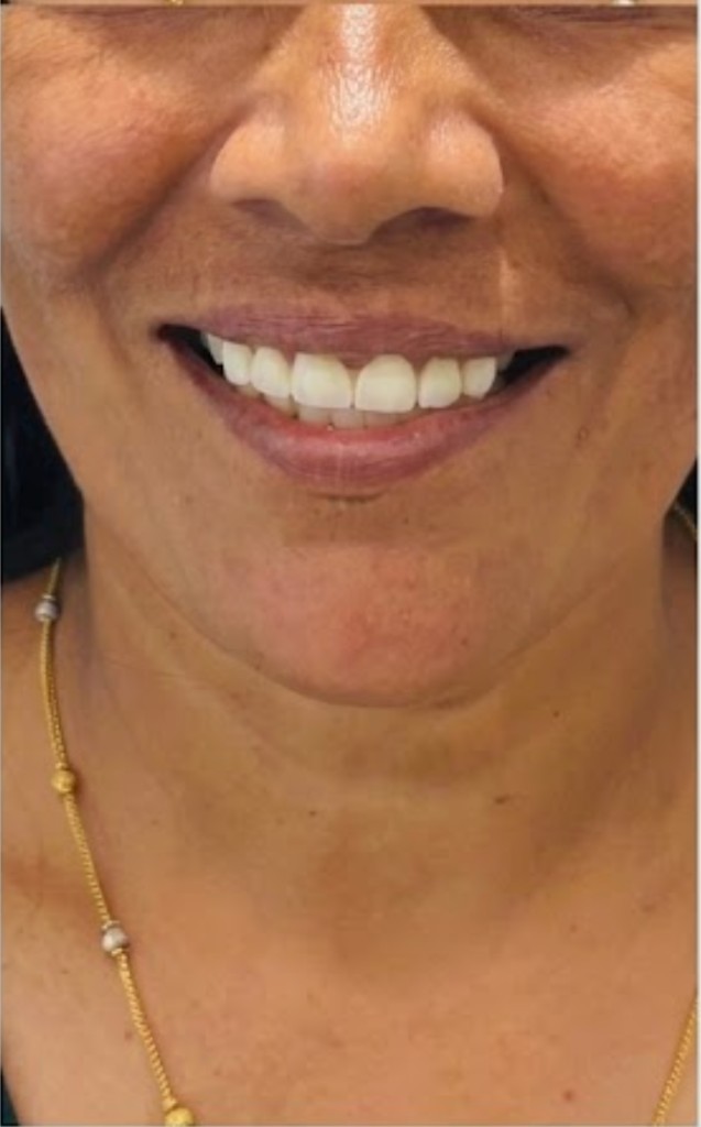 After Smile Makeover — Divya R.