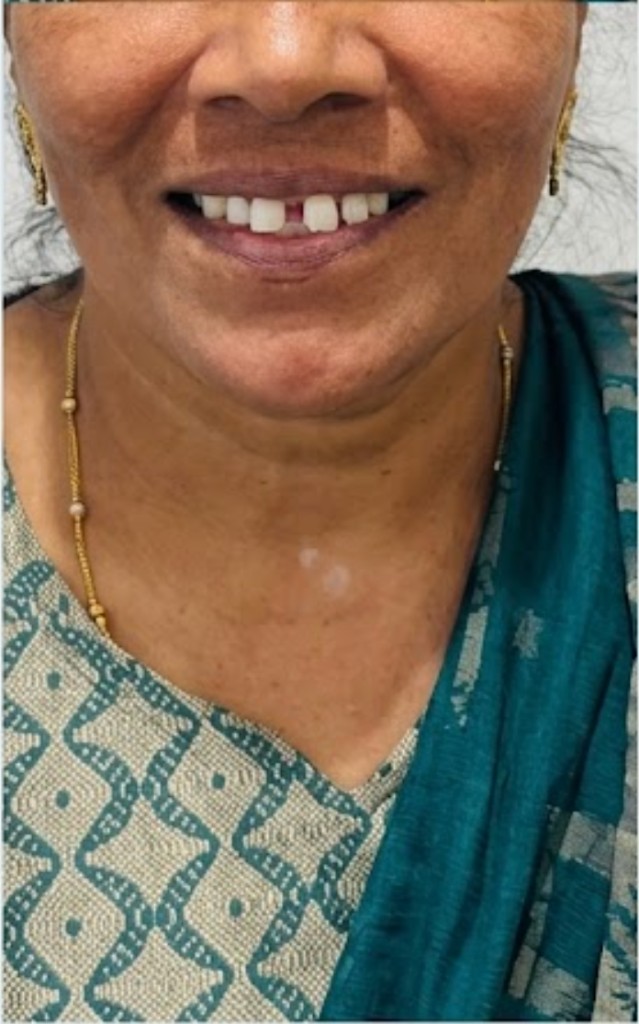 Before Smile Makeover — Divya R.