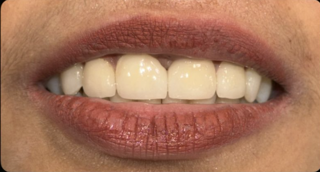 After Cosmetic Veneers — Meera K.