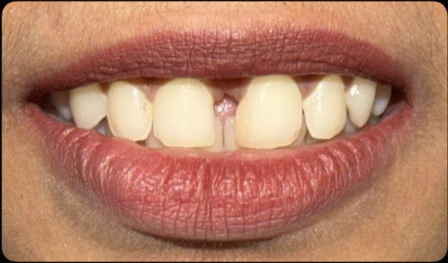 Before Cosmetic Veneers — Meera K.