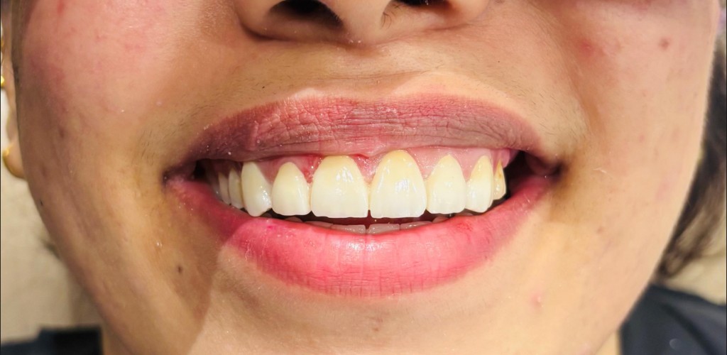 After Smile Makeover — Ayesha H.