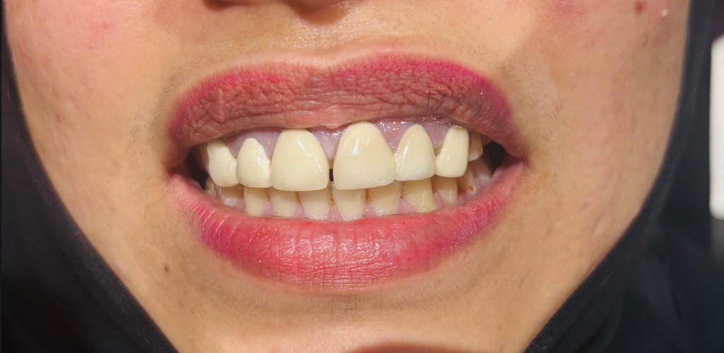 Before Smile Makeover — Ayesha H.