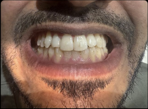 After Clear Aligners — Rahul M.