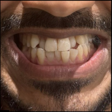 Before Clear Aligners — Rahul M.
